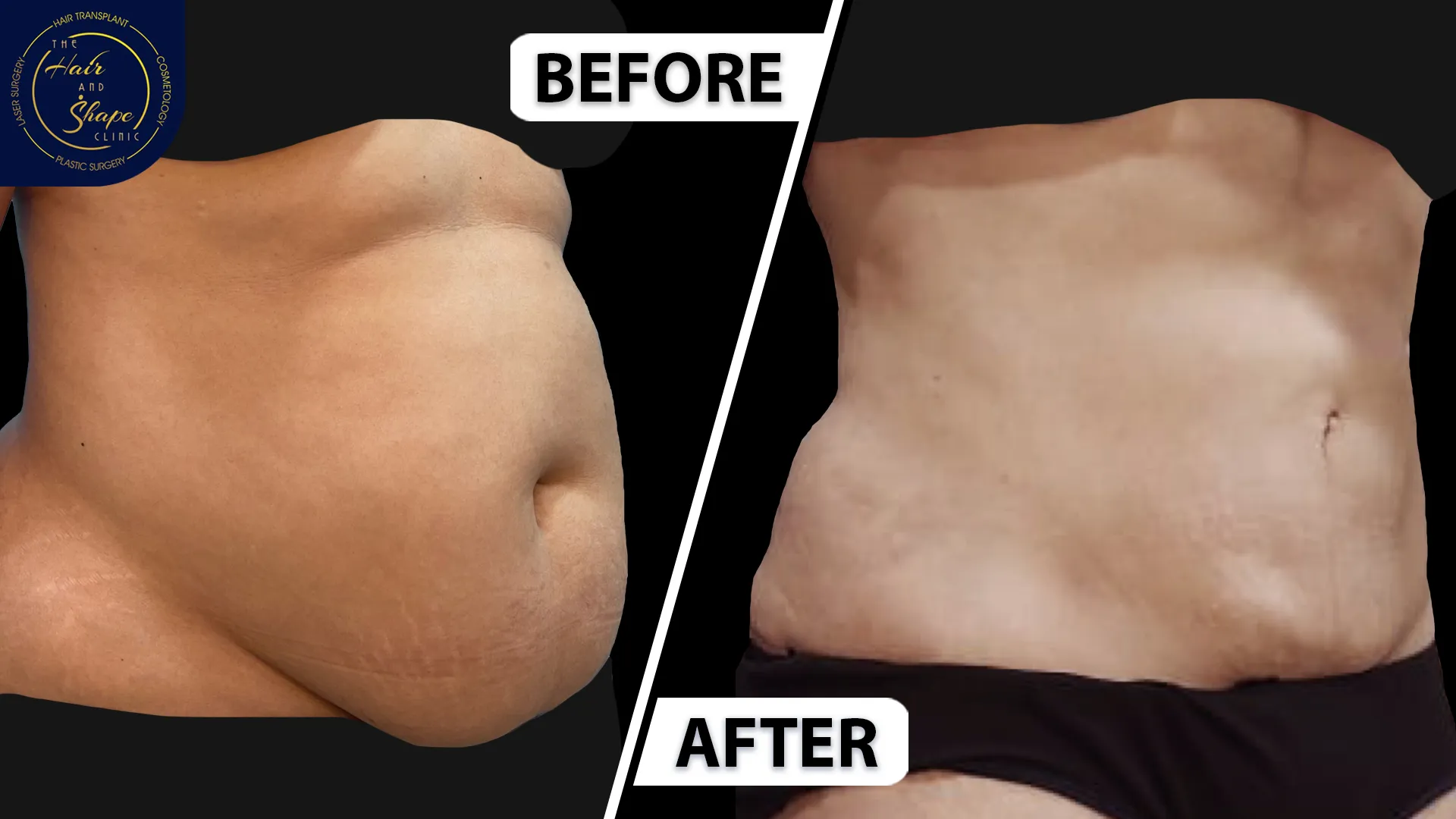 Tummy Tuck result2
